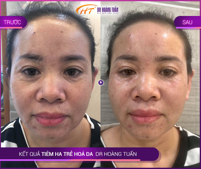 Kết quả tiêm HA trẻ hoá da tại Thẩm mỹ Hoàng Tuấn